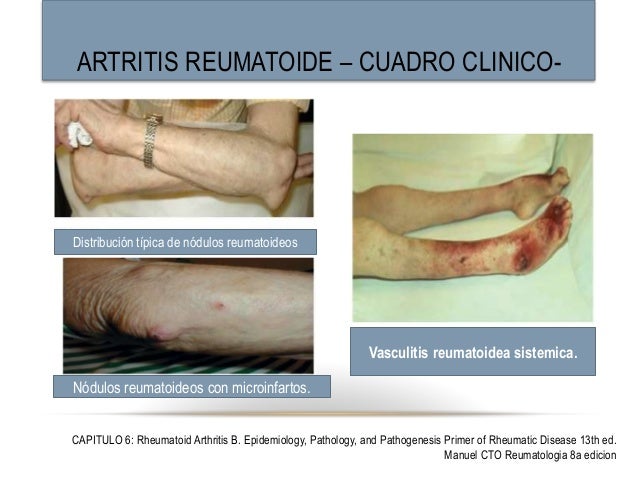 artritis reumatoide cuadro clinico artritis reumatoide artritis reumatoide cuadro clinico artritis reumatoide