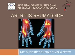 HOSPITAL GENERAL REGIONAL
DR. RAFAEL PASCACIO GAMBOA

ARTRITIS REUMATOIDE

MIP. GUTIERREZ RUEDAS ELVIS ALBERTO

 