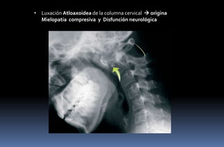 • Luxación Atloaxoidea de la columna cervical  origina
Mielopatia compresiva y Disfunción neurológica

 