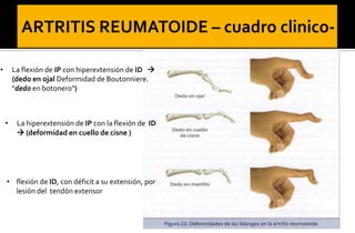 •

La flexión de IP con hiperextensión de ID 
(dedo en ojal Deformidad de Boutonniere.
"dedo en botonero")

•

La hiperextensión de IP con la flexión de ID
 (deformidad en cuello de cisne )

• flexión de ID, con déficit a su extensión, por
lesión del tendón extensor

 
