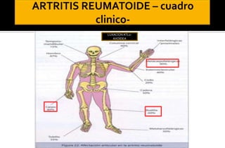 LUXACION ATL0AXOIDEA

 