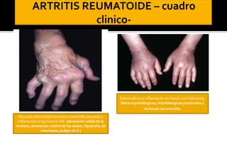 Edema difuso e inflamación en manos con Poliartritis,
Metacarpofalángicas, interfalangicas proximales y
muñecas con sinovitis.
Marcada deformidad sinovial e hipertrofia asociada a
inflamación progresiva en AR. (desviación radial de la
muñeca, desviación cubital de los dedos, hipotrofia de
interóseos, pulgar en Z.)

 