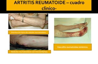 Distribución típica de nódulos reumatoideos

Vasculitis reumatoidea sistémica.
Nódulos reumatoideos con microinfartos.

 