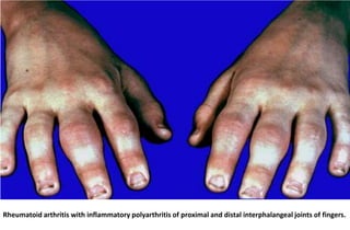 Rheumatoid arthritis with inflammatory polyarthritis of proximal and distal interphalangeal joints of fingers.

 