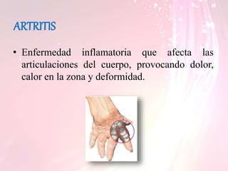ARTRITIS
• Enfermedad inflamatoria que afecta las
articulaciones del cuerpo, provocando dolor,
calor en la zona y deformidad.
 