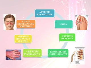 ARTRITIS
REUMATOIDE
GOTA
ESPONDILITIS
ANQUILOSANTE
ARTRITIS
REACTIVA
ARTRITIS
PSORIÁSICA
ARTRITIS
IDIOPÁTICA
JUVENIL
LUPUS
ERITEMATOSO
SISTÉMICO
 