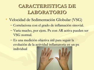 Vsg Lab Artritis reumatoide | PPT