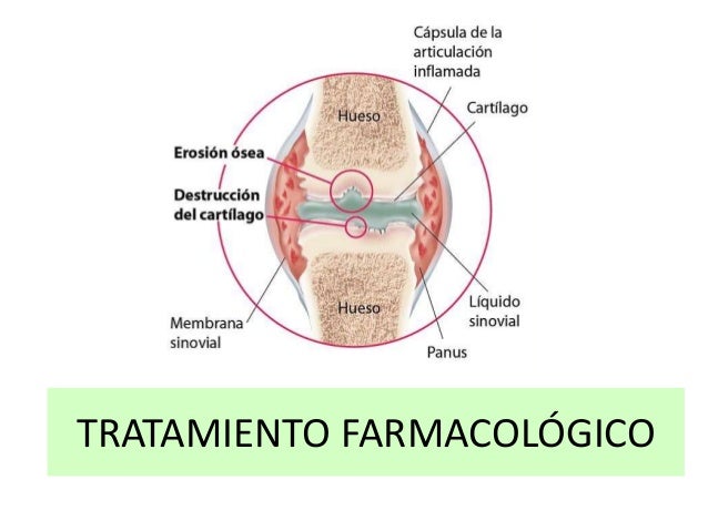 Artritis Reumatoide Definicin