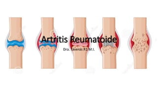 Artritis Reumatoide
Dra. Taveras R1 M.I.
 