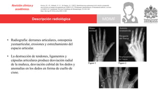Descripción radiológica
Revisión clínica y
académica.
MDMF
Orozco, B. J. D., Imbachí, S. A. J., & Ospina, A. I. (2022). Manifestaciones pulmonares de la artritis reumatoide,
una revisión en tiempos de pandemia por SARS-CoV-2 [Pulmonary manifestations of rheumatoid arthritis, a review
in SARS-CoV-2 pandemia]. Revista Colombiana de Reumatología, 29, S56–S65.
https://doi.org/10.1016/j.rcreu.2020.12.005
• Radiografía: derrames articulares, osteopenia
yuxtaarticular, erosiones y estrechamiento del
espacio articular.
• La destrucción de tendones, ligamentos y
cápsulas articulares produce desviación radial
de la muñeca, desviación cubital de los dedos y
anomalías en los dedos en forma de cuello de
cisne.
 