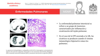 Enfermedades Pulmonares
Revisión clínica y
académica.
MDMF
Kim, E. J., Collard, H. R., & King, T. E., Jr (2009). Rheumatoid arthritis-associated interstitial lung disease: the relevance
of histopathologic and radiographic pattern. Chest, 136(5), 1397–1405. https://doi.org/10.1378/chest.09-0444
• La enfermedad pulmonar intersticial se
refiere a un grupo de trastornos
caracterizados por inflamación y
cicatrización del tejido pulmonar.
• En el caso de la EPI asociada a la AR, las
cicatrices se producen cuando el sistema
inmunológico hiperactivo ataca los
pulmones.
La apariencia histopatológica y radiográfica de RA-ILD es heterogénea y principalmente
imita los dos patrones siguientes observados en las neumonías intersticiales idiopáticas
(PII): neumonía intersticial habitual (NIU) y neumonía intersticial no específica (NSIP).
 