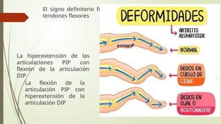El signo definitorio frecuente de RA es la tenosinovitis de
tendones flexores
La hiperextensión de las
articulaciones PIP con
flexión de la articulación
DIP
La flexión de la
articulación PIP con
hiperextensión de la
articulación DIP
 