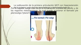 La subluxación de la primera articulación MCP con hiperextensión
de la primera articulación interfalángica (deformidad en Z)
Por lo regular surge más tarde la inflamación crónica del tobillo y de
las regiones mesotarsianas, lo cual puede ocasionar el llamado pie
planovalgo (“plano”).
 
