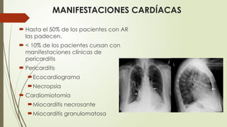 MANIFESTACIONES CARDÍACAS
 Hasta el 50% de los pacientes con AR
las padecen.
 < 10% de los pacientes cursan con
manifestaciones clínicas de
pericarditis
 Pericarditis
Ecocardiograma
Necropsia
 Cardiomiotomía
Miocarditis necrosante
Miocarditis granulomatosa
 