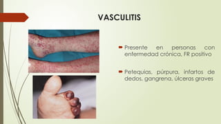 VASCULITIS
 Presente en personas con
enfermedad crónica, FR positivo
 Petequias, púrpura, infartos de
dedos, gangrena, úlceras graves
 