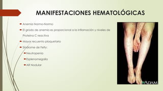 MANIFESTACIONES HEMATOLÓGICAS
 Anemia Normo-Normo
 El grado de anemia es proporcional a la inflamación y niveles de
Proteína C reactiva
 Mayor recuento plaquetario
 Síndrome de Felty:
Neutropenia
Esplenomegalia
AR Nodular
 