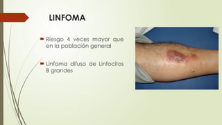 LINFOMA
 Riesgo 4 veces mayor que
en la población general
 Linfoma difuso de Linfocitos
B grandes
 