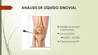 ANÁLISIS DE LÍQUIDO SINOVIAL
 Refleja el estado
inflamatorio
 Leucocitosis
5,000 – 50,000
 Presencia de FR
 