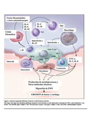 Artritis Reumatoidea