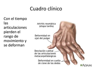 Cuadro clínico
Con el tiempo
las
articulaciones
pierden el
rango de
movimiento y
se deforman
 