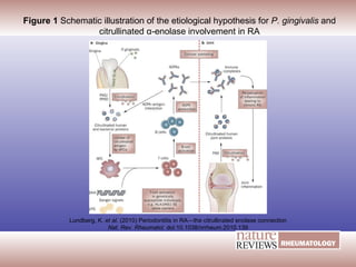 Figure 1  Schematic illustration of the etiological hypothesis for  P. gingivalis  and citrullinated α-enolase involvement in RA Lundberg, K.  et al.   (2010)  Periodontitis in RA—the citrullinated enolase connection Nat. Rev. Rheumatol.  doi:10.1038/nrrheum.2010.139 