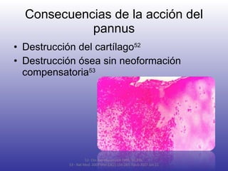 Consecuencias de la acción del pannus Destrucción del cartílago 52 Destrucción ósea sin neoformación compensatoria 53 52-  Clin Exp Rheumatol 1998; 16:245. 53 - Nat Med. 2007 Mar;13(2):156-163. Epub 2007 Jan 21 