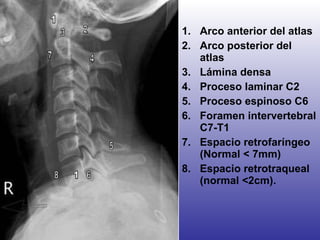 Arco anterior del atlas Arco posterior del atlas Lámina densa Proceso laminar C2 Proceso espinoso C6 Foramen intervertebral C7-T1 Espacio retrofaríngeo  (Normal < 7mm) Espacio retrotraqueal (normal  <2cm).  