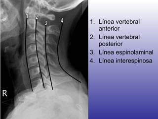 Línea vertebral anterior Línea vertebral posterior Línea espinolaminal Línea interespinosa 