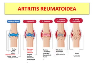 ARTRITIS REUMATOIDEA
Membrana
sinovial
inflamada
Hueso y
cartílago
erosionado
gradualmente
.
Perdida
de cartílago
importante
Exposición de
hueso
.
Articulación
invadida por
tejido conectivo
Hueso
fusionado
Cartílago
Hueso
Capsula
articular
Memhraba sinovial
Cavidad articular
con liquido sinovial
 
