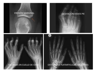 EROSIÓN MARGINAL DESVIACIÓN DEDOS PIE
FALANGES EN CUELLO DE CISNE OSTEOPENIA YUXTARTICULAR, EROSIONES
 