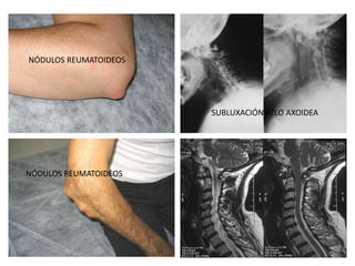 NÓDULOS REUMATOIDEOS
NÓDULOS REUMATOIDEOS
SUBLUXACIÓN ATLO AXOIDEA
 