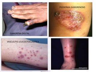 GANGRENA DIGITAL
VASCULITIS LEUCOCITOCLÁSTICA
PIODERMA GANGRENOSO
 