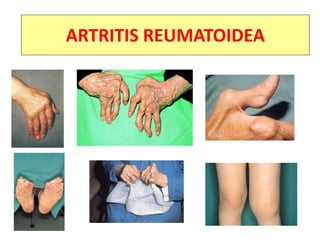 ARTRITIS REUMATOIDE:
La enfermedad (7)
Deformidades articulares
ARTRITIS REUMATOIDEA
 