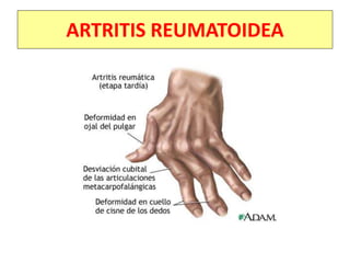ARTRITIS REUMATOIDEA
 
