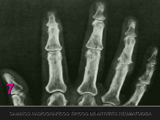 Artritis Reumatoidea Clínica.ppt