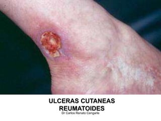 Artritis Reumatoidea Clínica.ppt