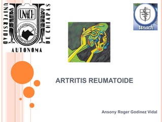 ARTRITIS REUMATOIDE Ansony Roger Godinez Vidal 