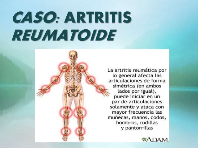 artritis reumatoide cuadro clinico artritis reumatoide caso clinico artritis reumatoide cuadro clinico artritis reumatoide caso clinico