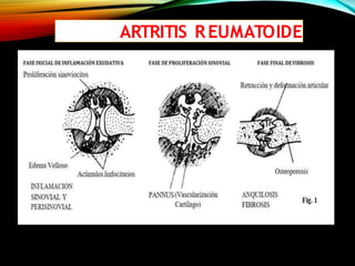 ARTRITIS REUMATOIDE
 