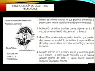 FISIOPATOLOGÍA DE LA ARTRITIS
REUMATOIDE
 