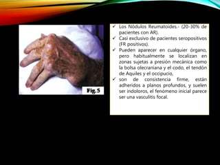  Los Nódulos Reumatoides.- (20-30% de
pacientes con AR).
 Casi exclusivo de pacientes seropositivos
(FR positivos).
 Pueden aparecer en cualquier órgano,
pero habitualmente se localizan en
zonas sujetas a presión mecánica como
la bolsa olecraniana y el codo, el tendón
de Aquiles y el occipucio,
 son de consistencia firme, están
adheridos a planos profundos, y suelen
ser indoloros, el fenómeno inicial parece
ser una vasculitis focal.
 