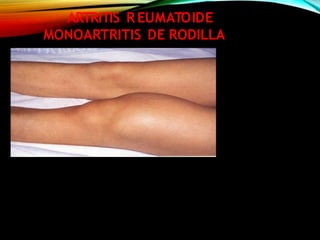 ARTRITIS R EUMATOIDE
MONOARTRITIS DE RODILLA
 