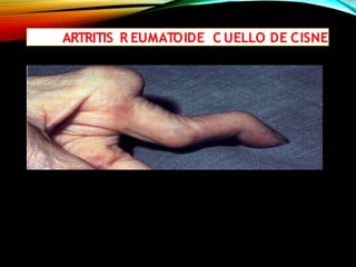 ARTRITIS R EUMATOIDE C UELLO DE CISNE
 