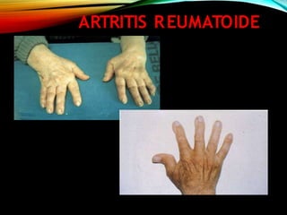 ARTRITIS REUMATOIDE
 