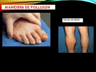 MANIOBRA DE POLLUSON
Quiste de Baker
 
