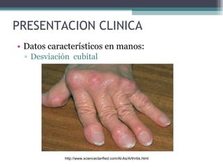 PRESENTACION CLINICA Datos característicos en manos: Desviación  cubital http://www.scienceclarified.com/Al-As/Arthritis.html 