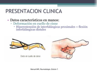 PRESENTACION CLINICA Datos característicos en manos: Deformación en cuello de cisne Hiperextensión de interfalángicas proximales + flexión interfalángicas distales Manual MIR, Reumatología. Edición 7. 
