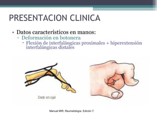 PRESENTACION CLINICA Datos característicos en manos: Deformación en botonera Flexión de interfalángicas proximales + hiperextensión interfalángicas distales Manual MIR, Reumatología. Edición 7. 