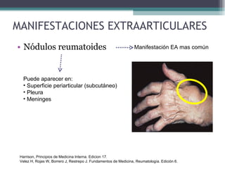 MANIFESTACIONES EXTRAARTICULARES Nódulos reumatoides Manifestación EA mas común Puede aparecer en: Superficie periarticular (subcutáneo) Pleura  Meninges Harrison, Principios de Medicina Interna. Edicion 17. Velez H, Rojas W, Borrero J, Restrepo J. Fundamentos de Medicina, Reumatología. Edición 6. 