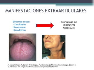 MANIFESTACIONES EXTRAARTICULARES SINDROME DE SJOGREN ASOCIADO Sintomas secos: Xeroftalmia Xerostomía Xerodermia 1. Velez H, Rojas W, Borrero J, Restrepo J. Fundamentos de Medicina, Reumatología. Edición 6. 2. http://www.nlm.nih.gov/medlineplus/spanish/ency/article/000456.htm 